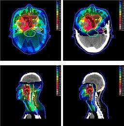 radiation-oncology