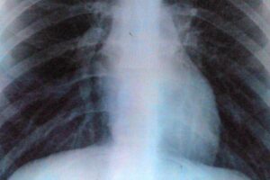 an x-ray of lungs